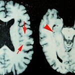 Shocking New Study Reveals Even Greater Prevalence of Brain Disease in Deceased NFL Players—What’s the Untold Truth?
