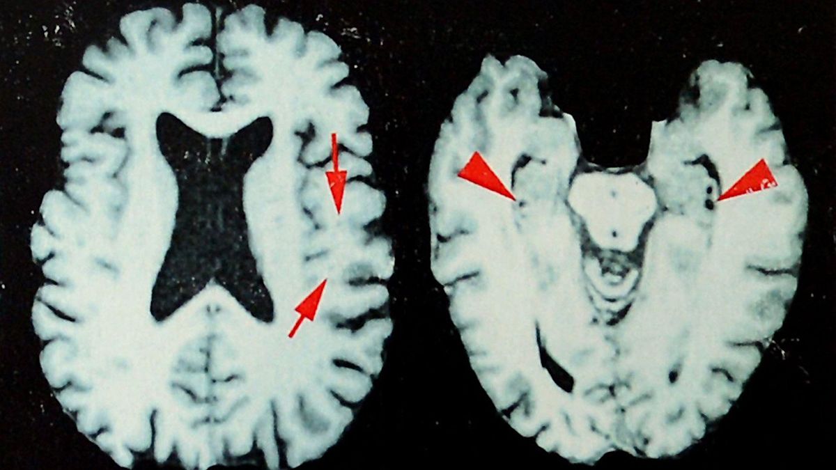 Shocking New Study Reveals Even Greater Prevalence of Brain Disease in Deceased NFL Players—What’s the Untold Truth?